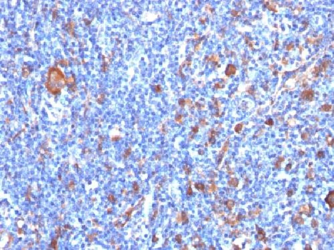 Immunohistochemical staining of human Hodgkin's lymphoma tissue using FSCN1 antibody