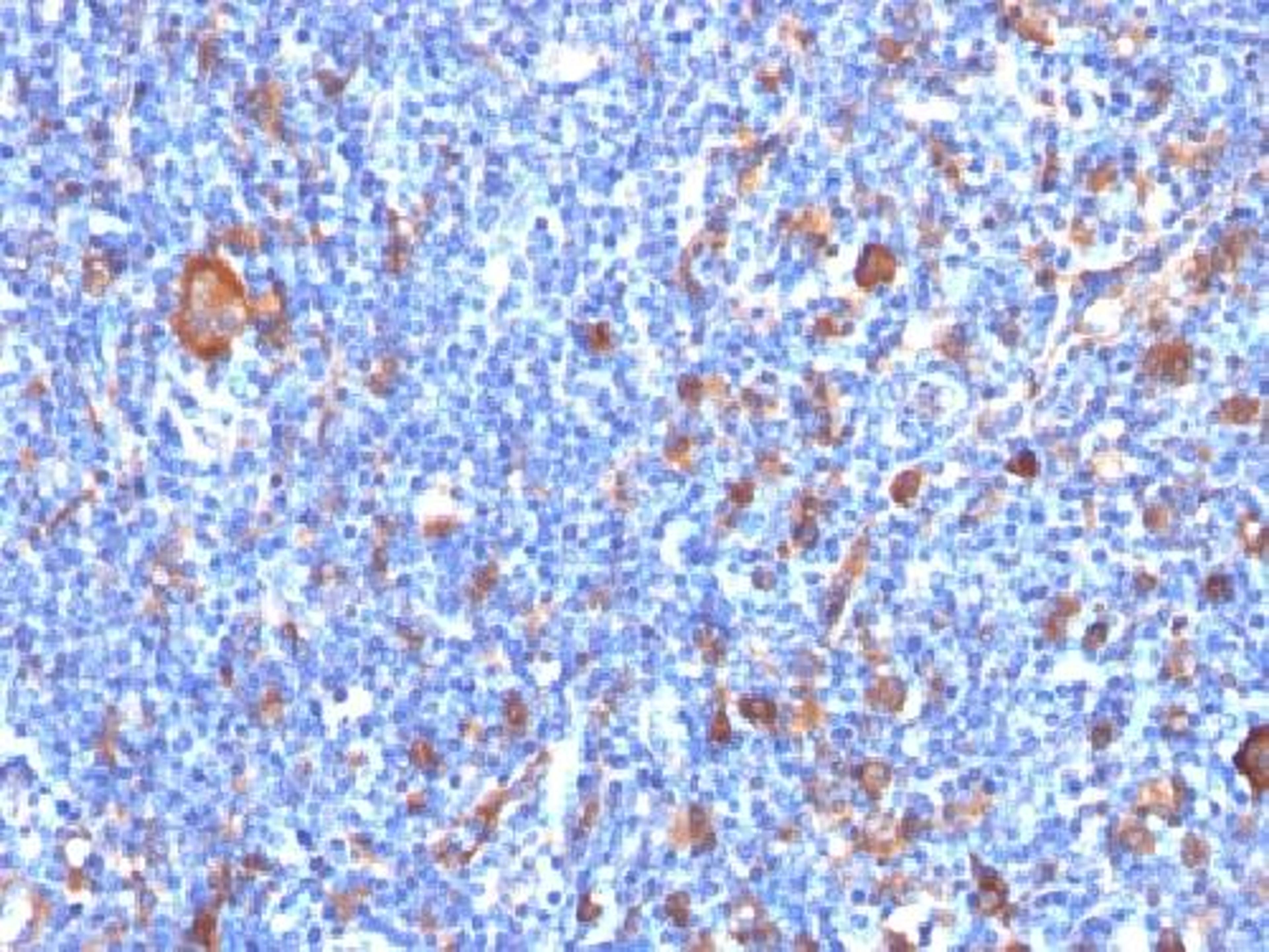 Immunohistochemical staining of human Hodgkin's lymphoma tissue using FSCN1 antibody