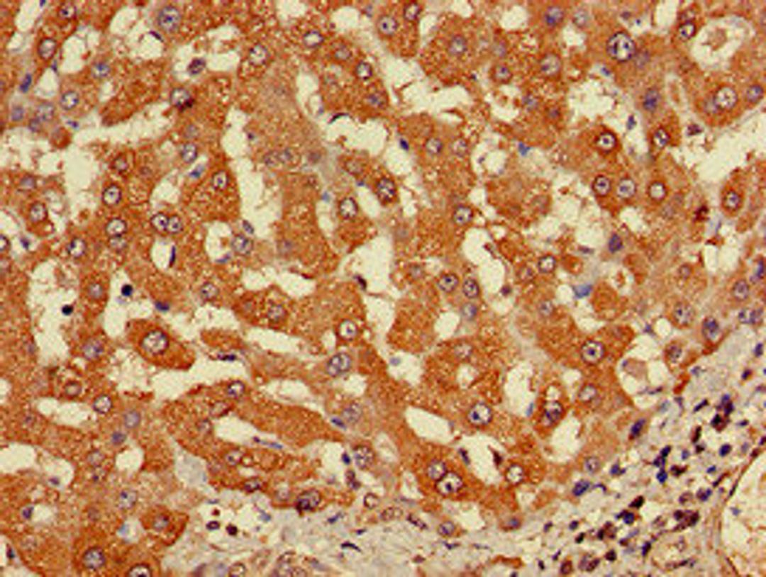 Immunohistochemistry of paraffin-embedded human liver cancer using CSB-PA747625LA01HU at dilution of 1:100
