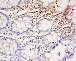 Immunohistochemical staining of human colon cancer tissue using AEBP1 antibody.