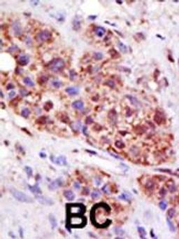 Formalin-fixed and paraffin-embedded human cancer tissue reacted with the primary antibody, which was peroxidase-conjugated to the secondary antibody, followed by DAB staining. BC = breast carcinoma; HC = hepatocarcinoma.