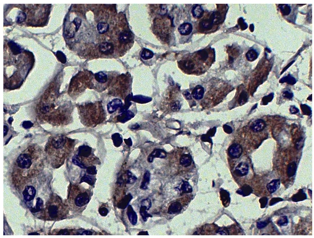 Human kidney cancer tissue was stained with Mouse Anti-Human MMP-3-UNLB (Cat. No. 99-771) followed by Goat Anti-Mouse IgG2a, Human ads-HRP .