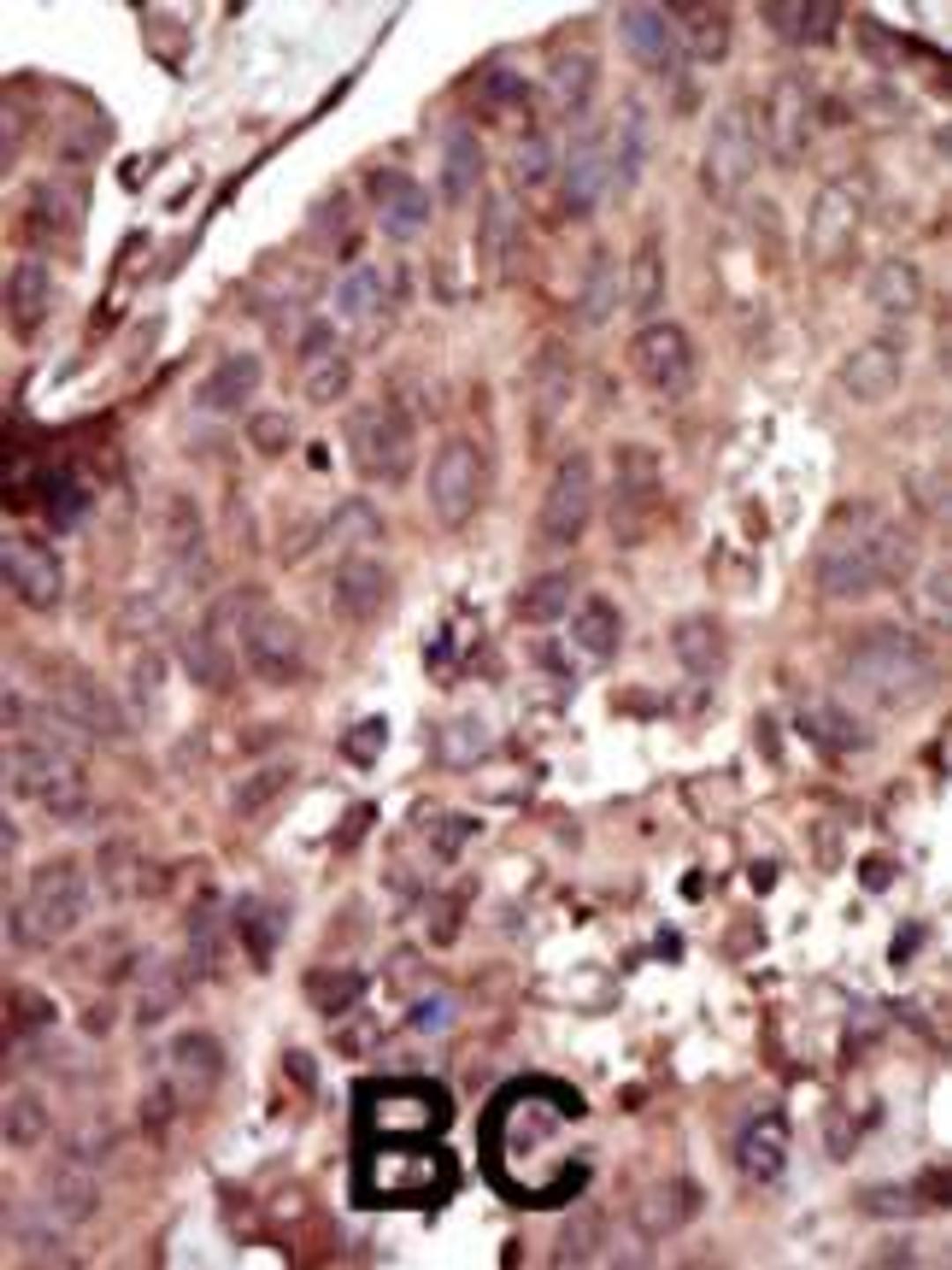 Formalin-fixed and paraffin-embedded human cancer tissue reacted with the primary antibody, which was peroxidase-conjugated to the secondary antibody, followed by AEC staining. BC = breast carcinoma; HC = hepatocarcinoma.