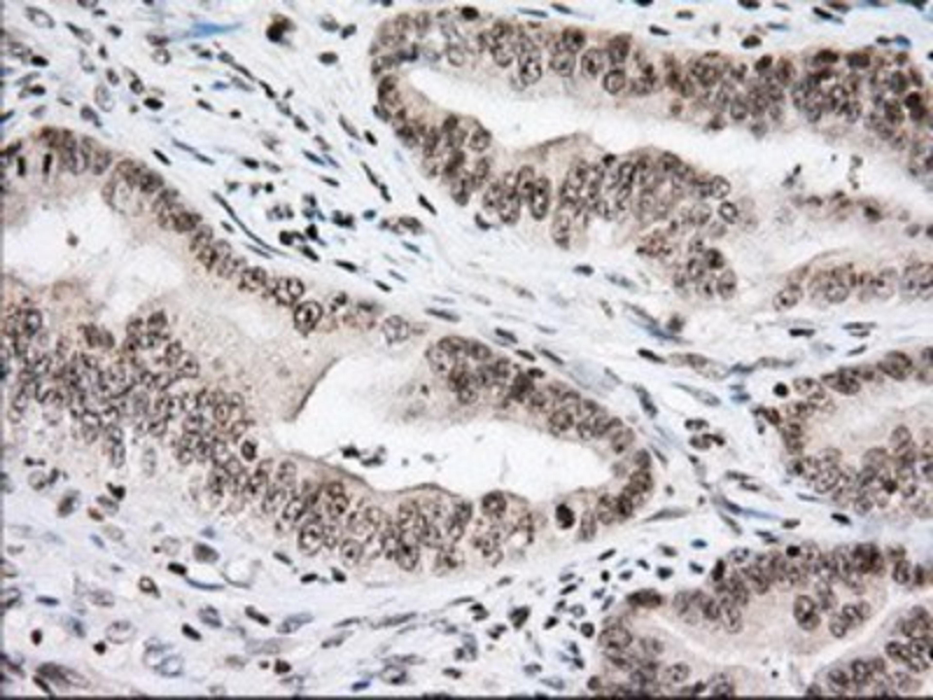 Immunohistochemistry-Paraffin: USP5 Antibody (2E3) [NBP2-02648] - Staining of paraffin-embedded Adenocarcinoma of Human colon tissue using anti-USP5 mouse monoclonal antibody.