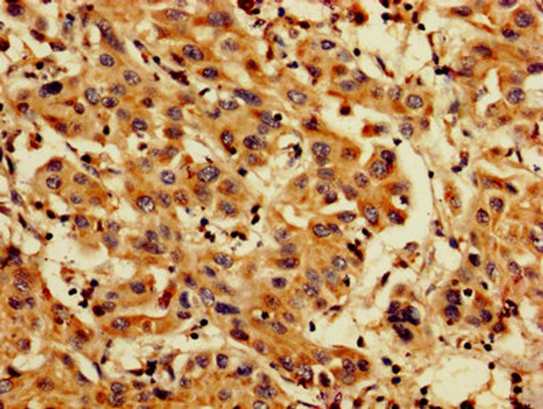 IHC image of CSB-PA04874A0Rb diluted at 1:200 and staining in paraffin-embedded human liver cancer performed on a Leica BondTM system. After dewaxing and hydration, antigen retrieval was mediated by high pressure in a citrate buffer (pH 6.0). Section was blocked with 10% normal goat serum 30min at RT. Then primary antibody (1% BSA) was incubated at 4&deg;C overnight. The primary is detected by a biotinylated secondary antibody and visualized using an HRP conjugated SP system.