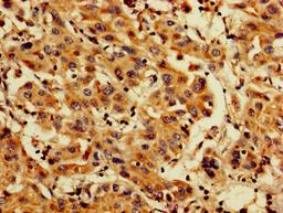 IHC image of CSB-PA04874A0Rb diluted at 1:200 and staining in paraffin-embedded human liver cancer performed on a Leica BondTM system. After dewaxing and hydration, antigen retrieval was mediated by high pressure in a citrate buffer (pH 6.0). Section was blocked with 10% normal goat serum 30min at RT. Then primary antibody (1% BSA) was incubated at 4&deg;C overnight. The primary is detected by a biotinylated secondary antibody and visualized using an HRP conjugated SP system.