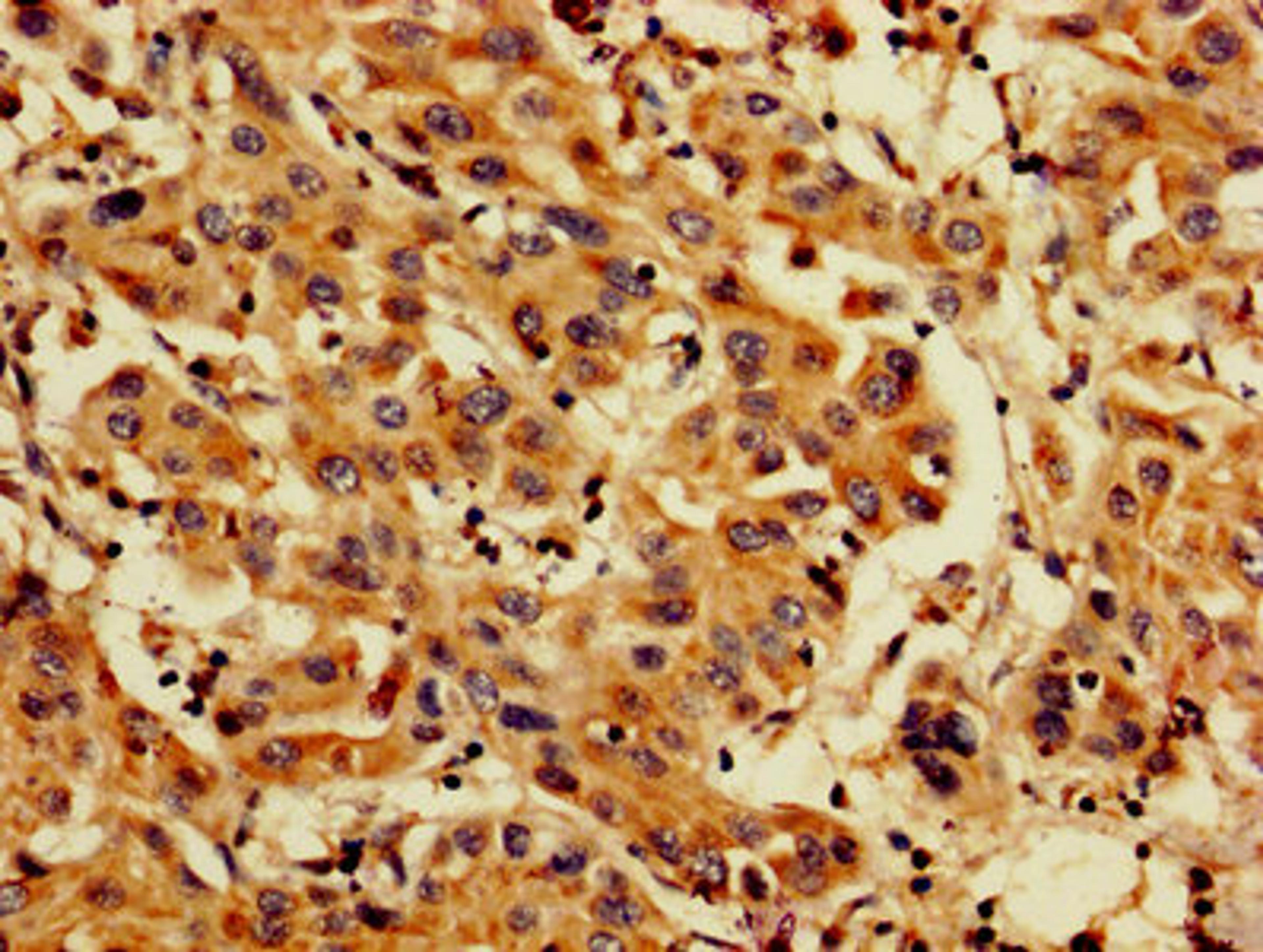 IHC image of CSB-PA04874A0Rb diluted at 1:200 and staining in paraffin-embedded human liver cancer performed on a Leica BondTM system. After dewaxing and hydration, antigen retrieval was mediated by high pressure in a citrate buffer (pH 6.0). Section was blocked with 10% normal goat serum 30min at RT. Then primary antibody (1% BSA) was incubated at 4&deg;C overnight. The primary is detected by a biotinylated secondary antibody and visualized using an HRP conjugated SP system.