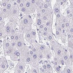 Immunohistochemistry: AKAP14 Antibody [NBP2-32580] - liver cancer