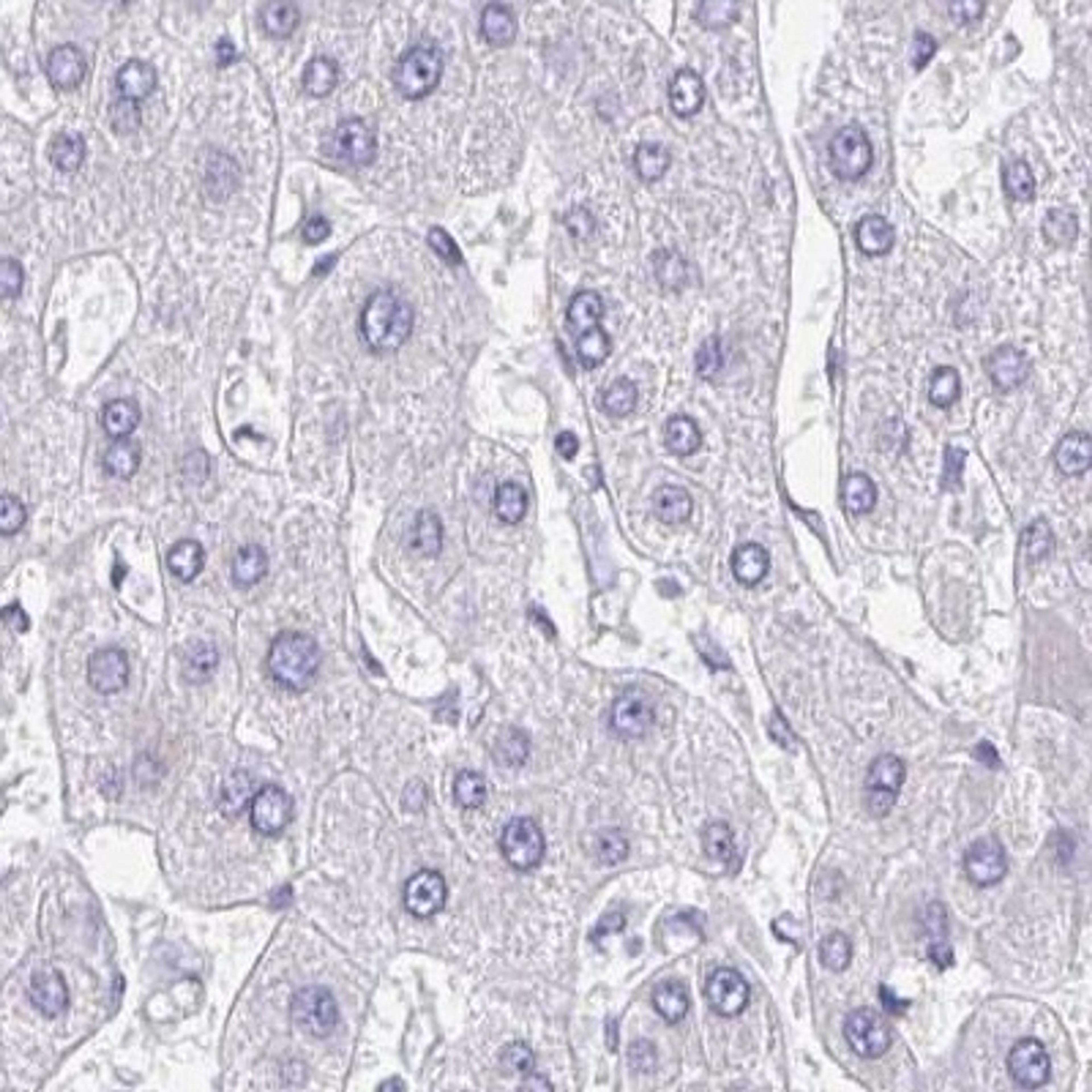 Immunohistochemistry: AKAP14 Antibody [NBP2-32580] - liver cancer