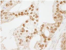 Immunohistochemistry-Paraffin: WDR77 Antibody [NB100-77305] - FFPE section of human  prostate carcinoma.   Affinity purified rabbit anti-WDR77 used at a dilution of 1:250. Detection: DAB staining using Immunohistochemistry Accessory Kit