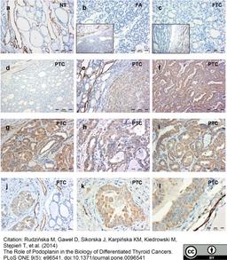 Mouse anti Human podoplanin antibody used for the detection of podoplanin in human thyroid tissue