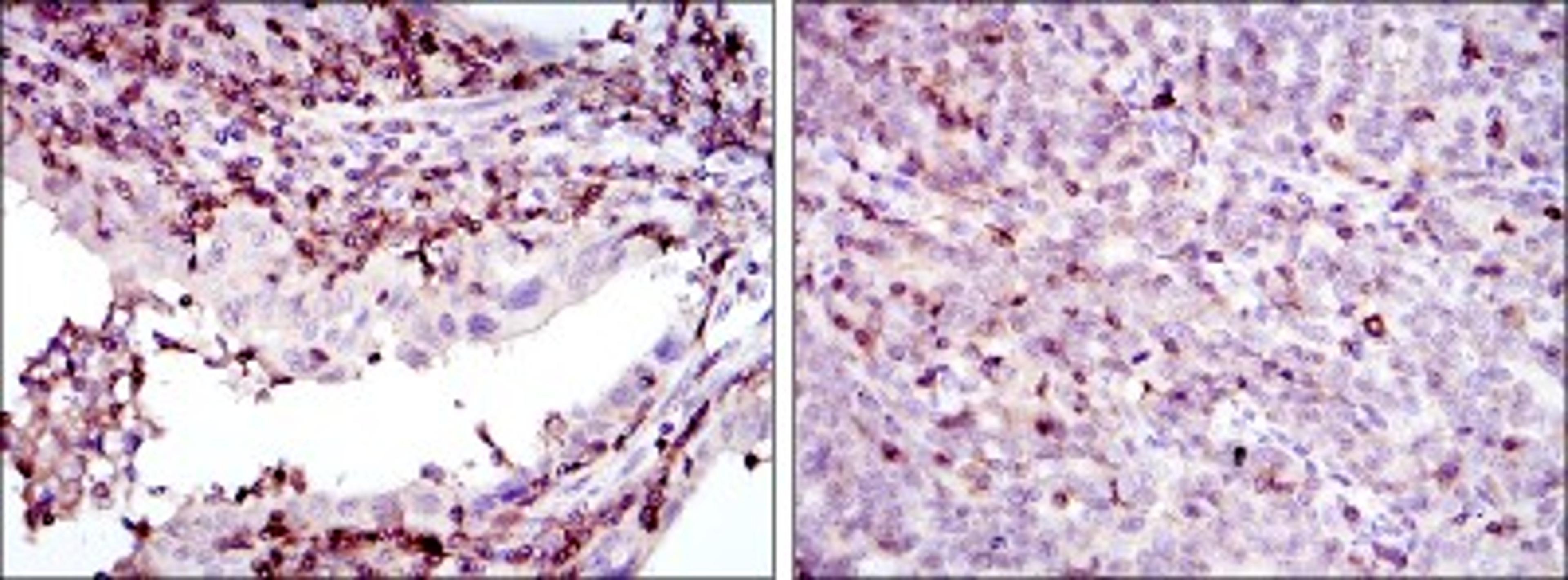 Immunohistochemistry: GRK2 Antibody (3F8) [NBP2-37611] - Immunohistochemical analysis of paraffin-embedded endometrial cancer tissues (left) and cervical cancer tissues (right) using GRK2 mouse mAb with DAB staining.