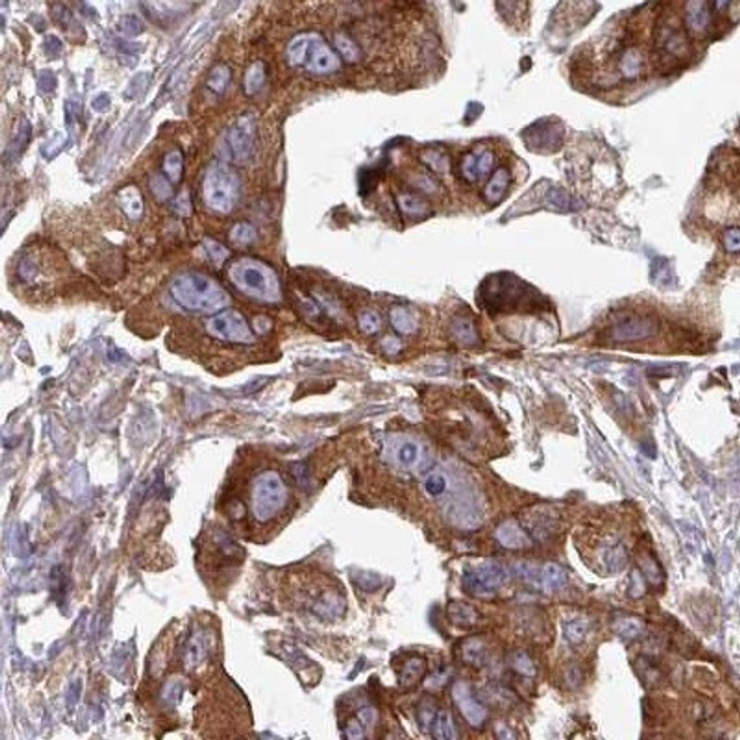 Immunohistochemistry: SNRNP25 Antibody [NBP2-32028] - pancreatic cancer