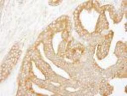 Immunohistochemistry-Paraffin: CORO1B Antibody [NB100-61040] - FFPE section of human prostate carcinoma.  Affinity purified rabbit anti-Coronin 2 used at a dilution of 1:250.