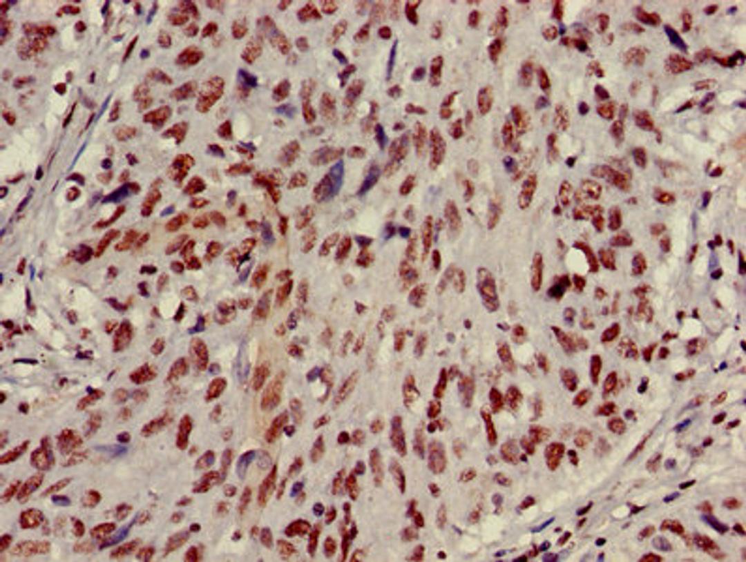 Immunohistochemistry of paraffin-embedded human lung cancer using CSB-PA010418PA27nme2HU at dilution of 1:100