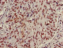 Immunohistochemistry of paraffin-embedded human lung cancer using CSB-PA010418PA27nme2HU at dilution of 1:100
