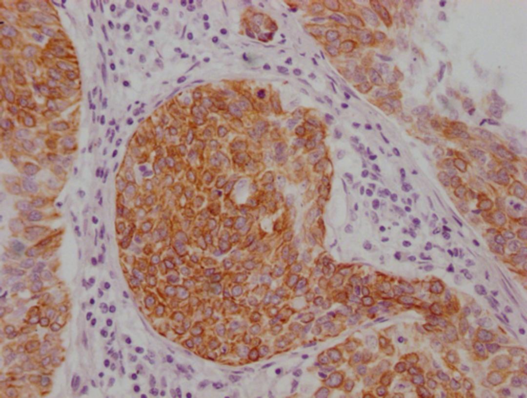 IHC image of CSB-MA589883 diluted at 1:100 and staining in paraffin-embedded human cervical cancer performed on a Leica BondTM system. After dewaxing and hydration, antigen retrieval was mediated by high pressure in a citrate buffer (pH 6.0). Section was blocked with 10% normal goat serum 30min at RT. Then primary antibody (1% BSA) was incubated at 4°C overnight. The primary is detected by a Goat anti-mouse IgG polymer labeled by HRP and visualized using 0.05% DAB.