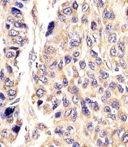 Antibody staining AGXT in Human hepatic carcinoma tissue sections by Immunohistochemistry (IHC-P - paraformaldehyde-fixed, paraffin-embedded sections).