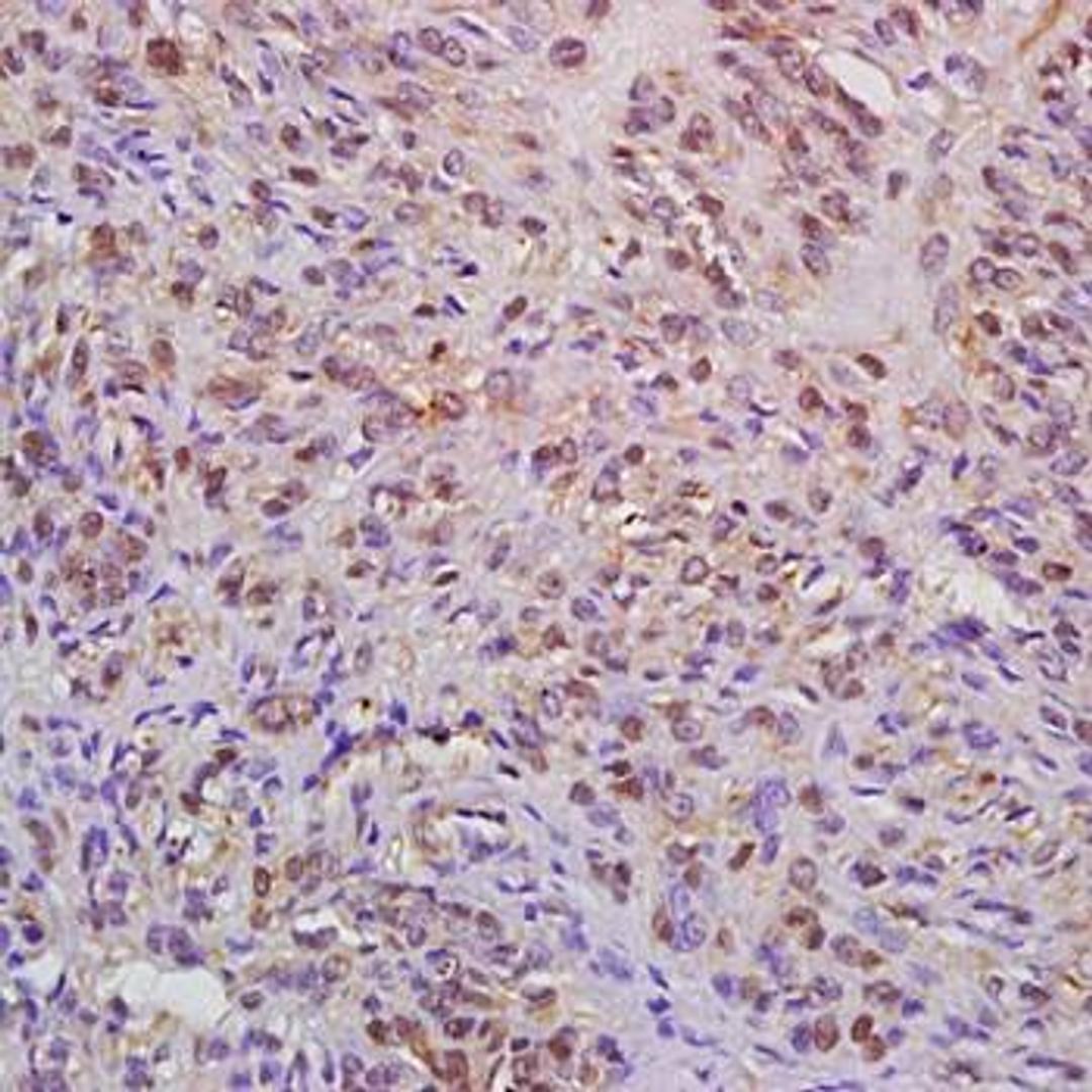 Immunohistochemical analysis of formalin-fixed and paraffin embedded human cervical carcinoma tissue (dilution at:1:200) using WAPL antibody