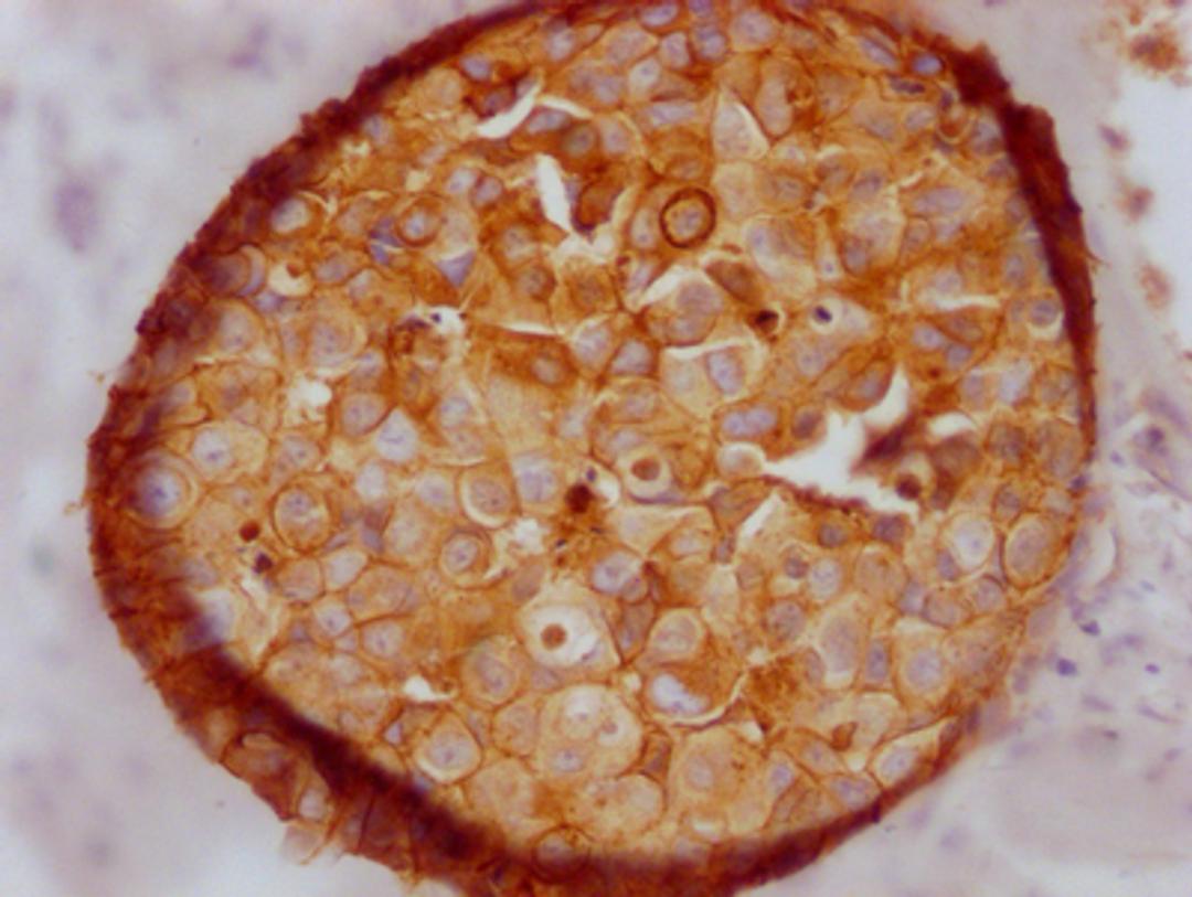 IHC image of CSB-RA576116A0HU diluted at 1:100 and staining in paraffin-embedded human breast cancer performed on a Leica BondTM system. After dewaxing and hydration, antigen retrieval was mediated by high pressure in a citrate buffer (pH 6.0). Section was blocked with 10% normal goat serum 30min at RT. Then primary antibody (1% BSA) was incubated at 4℃ overnight. The primary is detected by a Goat anti-rabbit IgG polymer labeled by HRP and visualized using 0.05% DAB.