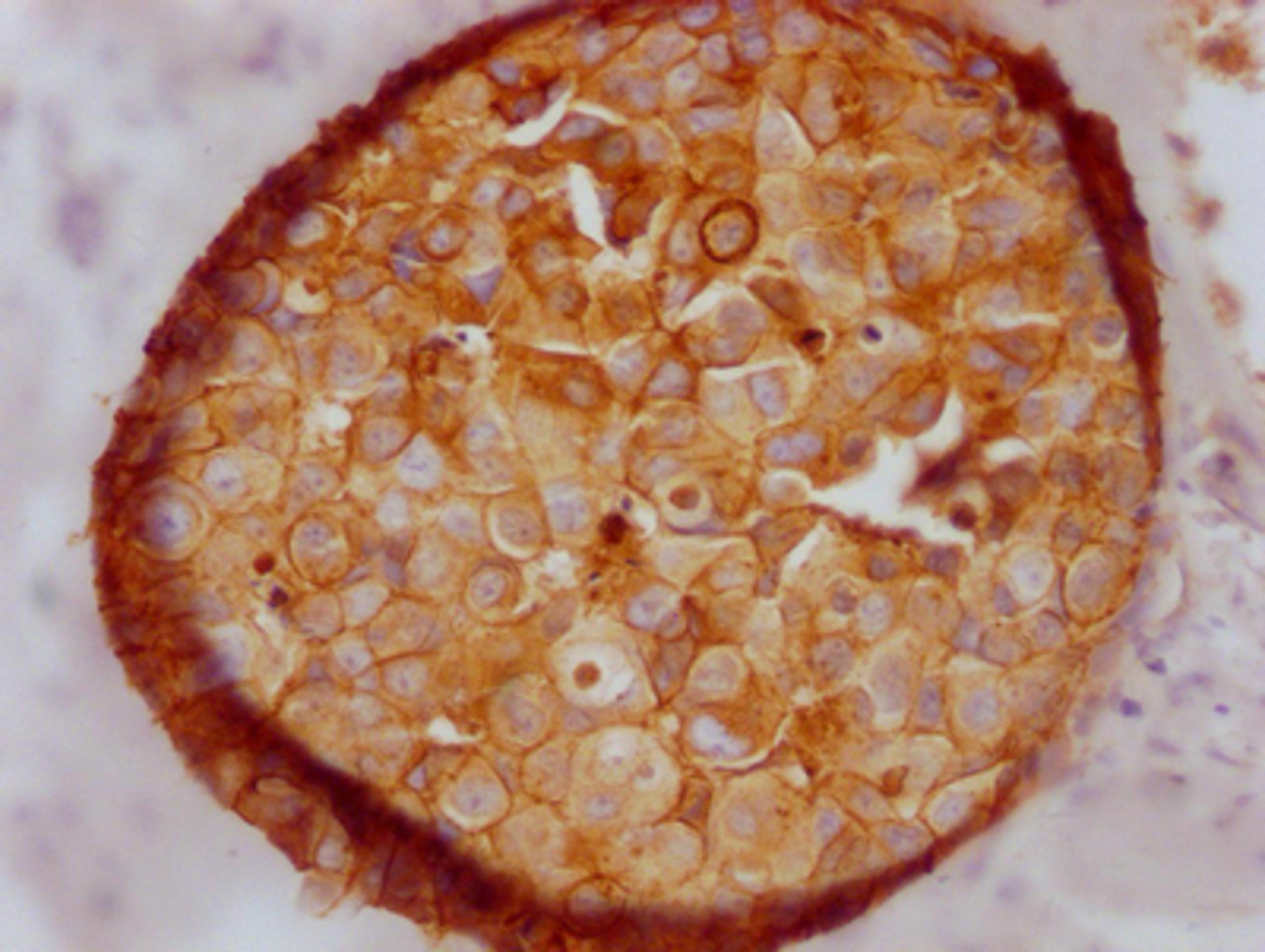 IHC image of CSB-RA576116A0HU diluted at 1:100 and staining in paraffin-embedded human breast cancer performed on a Leica BondTM system. After dewaxing and hydration, antigen retrieval was mediated by high pressure in a citrate buffer (pH 6.0). Section was blocked with 10% normal goat serum 30min at RT. Then primary antibody (1% BSA) was incubated at 4℃ overnight. The primary is detected by a Goat anti-rabbit IgG polymer labeled by HRP and visualized using 0.05% DAB.