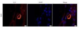 Immunofluorescence image of human thyroid carcinoma tissue using anti-APCDD1 (dilution at 1:100)