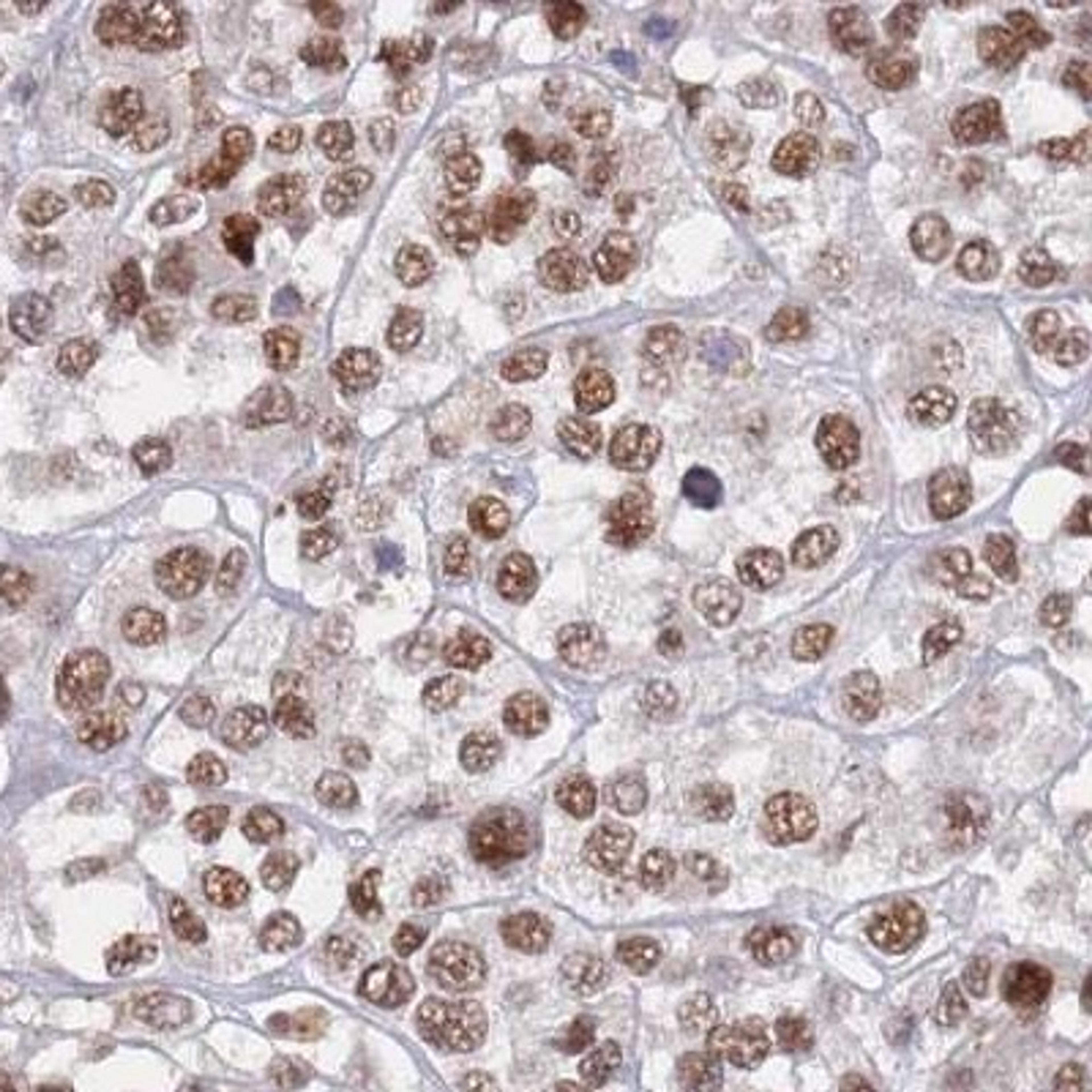 Immunohistochemistry-Paraffin: BOD1L Antibody [NBP2-34069] - melanoma