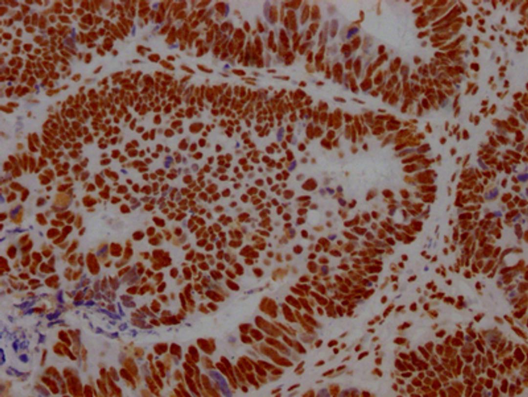 IHC image of CSB-RA289890A0HU diluted at 1:100 and staining in paraffin-embedded human ovarian cancer performed on a Leica BondTM system. After dewaxing and hydration, antigen retrieval was mediated by high pressure in a citrate buffer (pH 6.0). Section was blocked with 10% normal goat serum 30min at RT. Then primary antibody (1% BSA) was incubated at 4℃ overnight. The primary is detected by a Goat anti-rabbit IgG polymer labeled by HRP and visualized using 0.05% DAB.