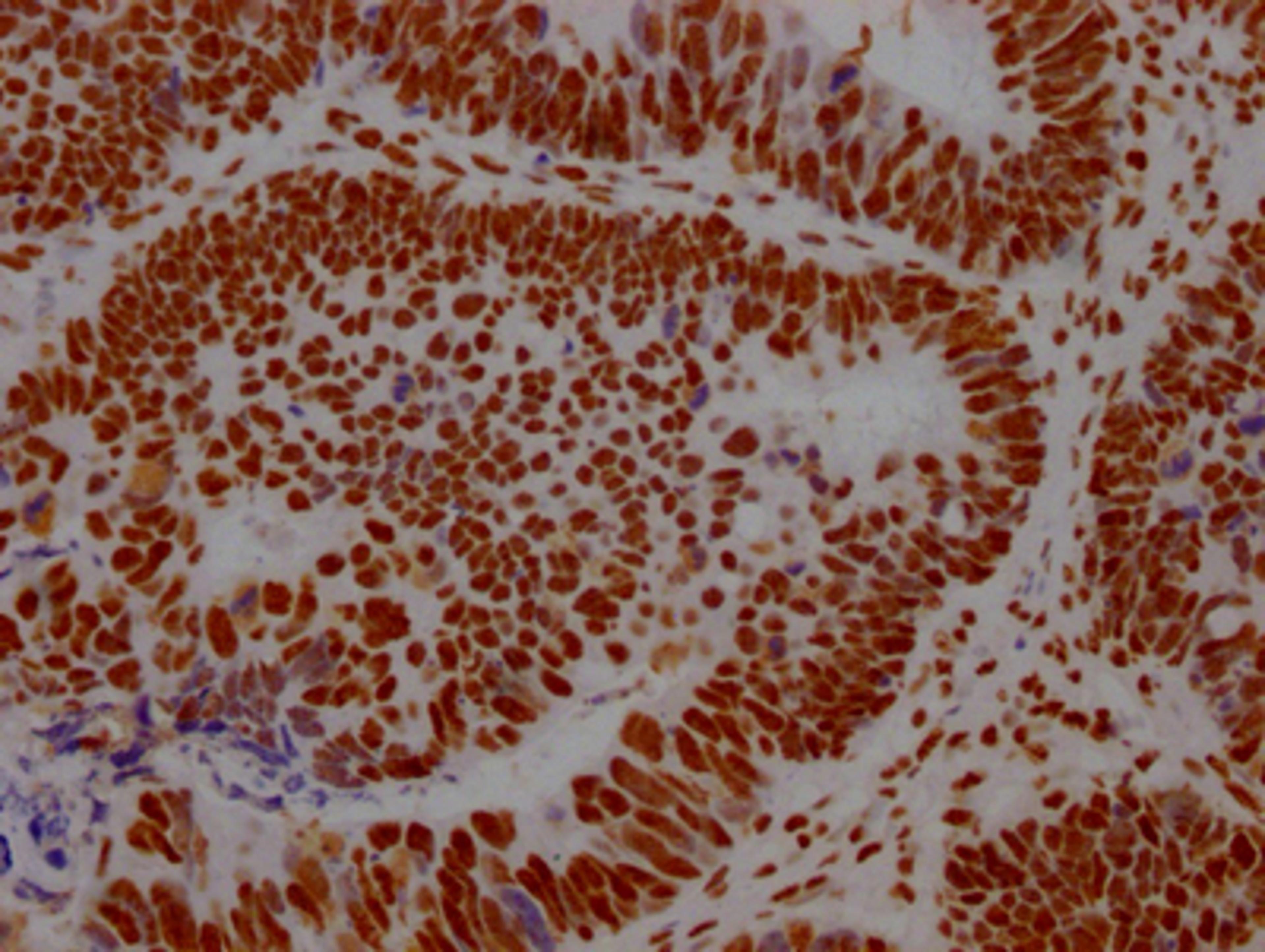 IHC image of CSB-RA289890A0HU diluted at 1:100 and staining in paraffin-embedded human ovarian cancer performed on a Leica BondTM system. After dewaxing and hydration, antigen retrieval was mediated by high pressure in a citrate buffer (pH 6.0). Section was blocked with 10% normal goat serum 30min at RT. Then primary antibody (1% BSA) was incubated at 4℃ overnight. The primary is detected by a Goat anti-rabbit IgG polymer labeled by HRP and visualized using 0.05% DAB.