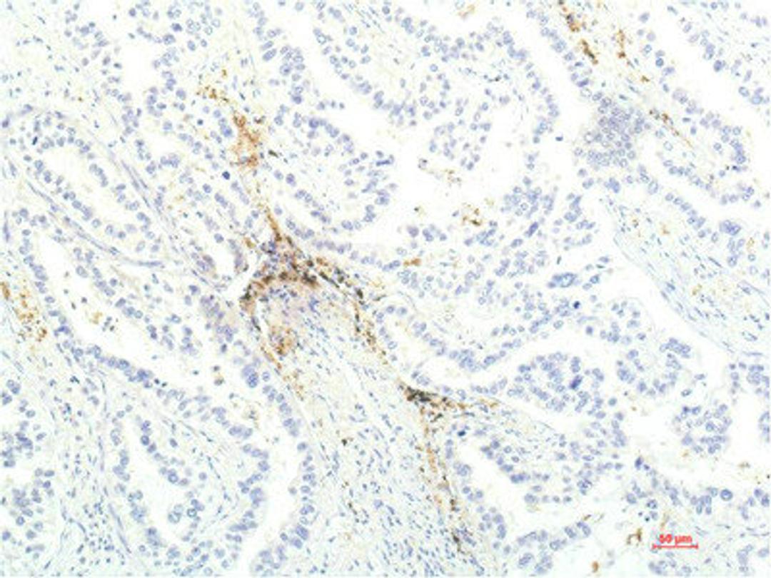 Immunohistochemical analysis of paraffin-embedded Human Lung Carcinoma Tissue using JAK1 Mouse mAb diluted at 1:200.