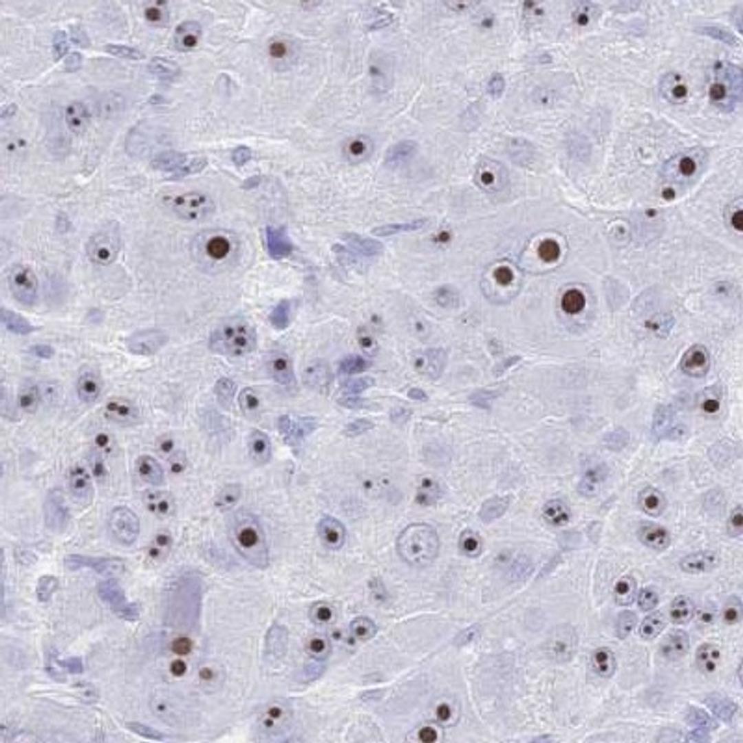 Immunohistochemistry: SCGB1D4 Antibody [NBP2-32549] - liver cancer