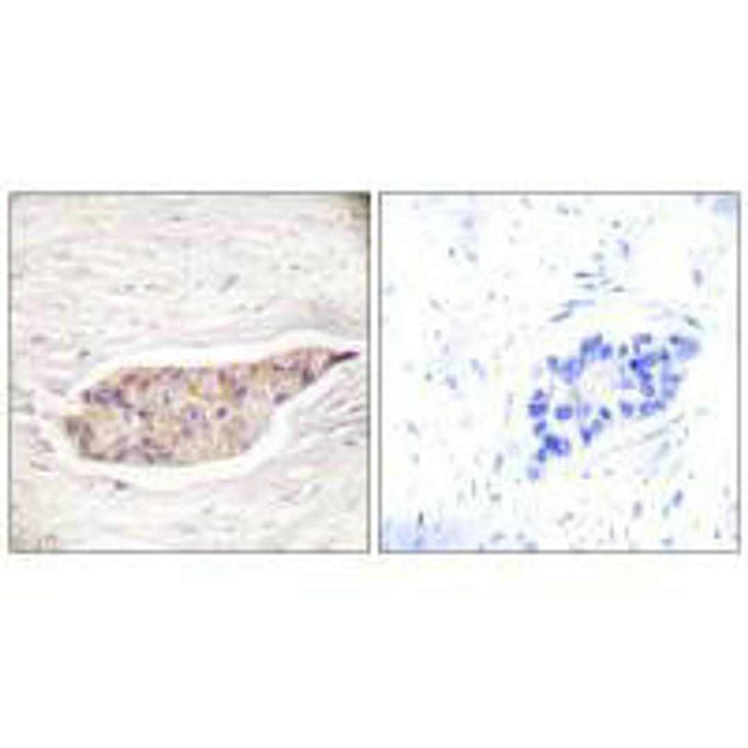 Immunohistochemical analysis of paraffin-embedded human breast carcinoma tissue using Annexin A6 antibody.