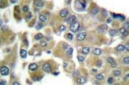 Immunohistochemistry: Cytokeratin 16 Antibody [NB100-91842] - - Immunohistochemistry  (IHC)  analyzes of Keratin 16  antibody in paraffin-embedded human breast carcinoma  tissue.