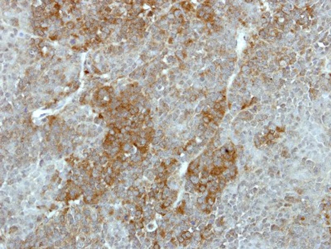 Immunohistochemistry-Paraffin: GALK2 Antibody [NBP1-33401] - Paraffin-embedded MCF7 xenograft, using antibody at 1:500 dilution.