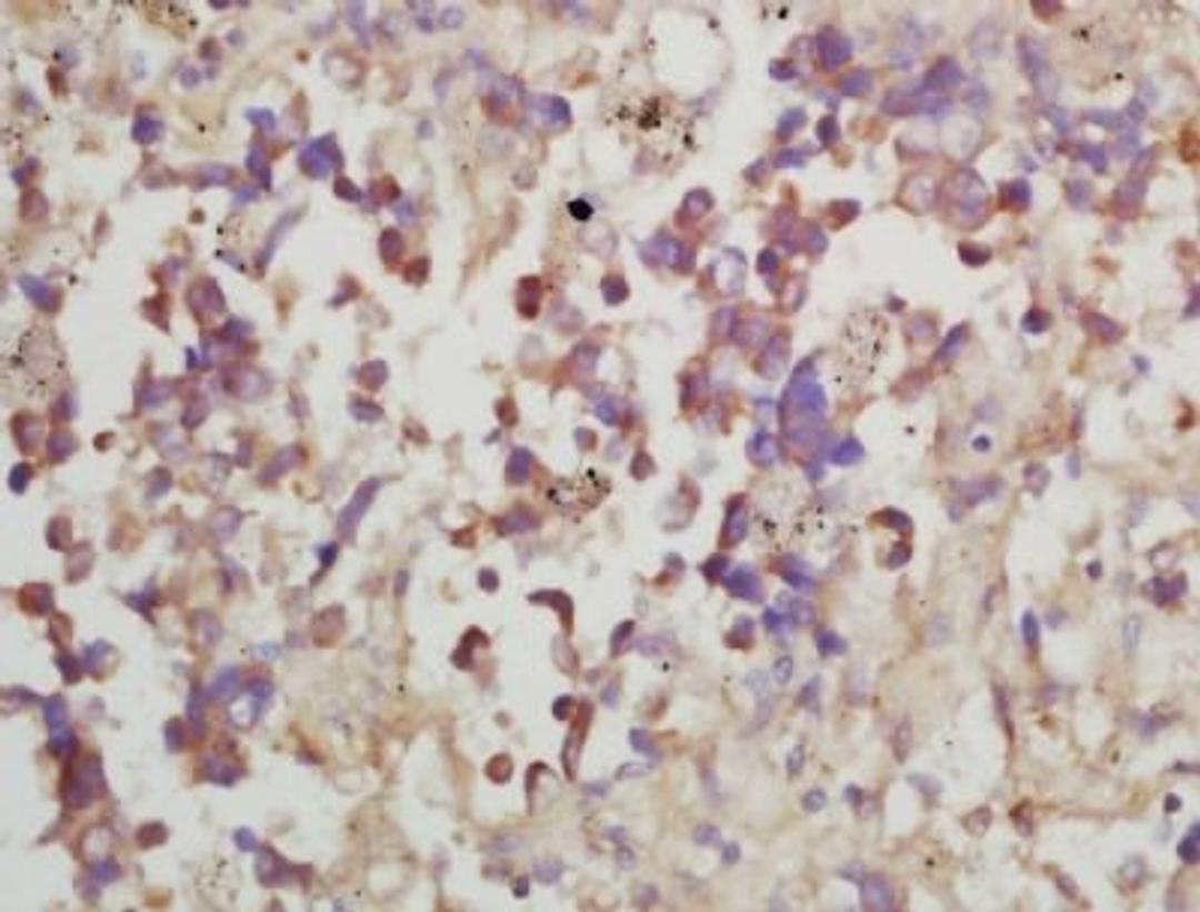 Immunohistochemical analysis of formalin-fixed paraffin embedded human lung cancer tissue using MMP10 antibody (dilution at 1:200)