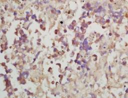 Immunohistochemical analysis of formalin-fixed paraffin embedded human lung cancer tissue using MMP10 antibody (dilution at 1:200)