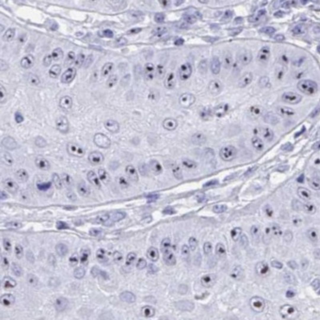 Immunohistochemistry: TBC1D29 Antibody [NBP2-32437] - skin cancer