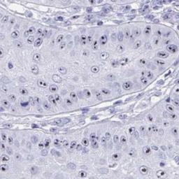 Immunohistochemistry: TBC1D29 Antibody [NBP2-32437] - skin cancer