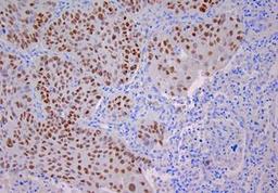 Immunohistochemical staining of human lung squamous cell carcinoma using p40 Protein, Delta-Np63 antibody