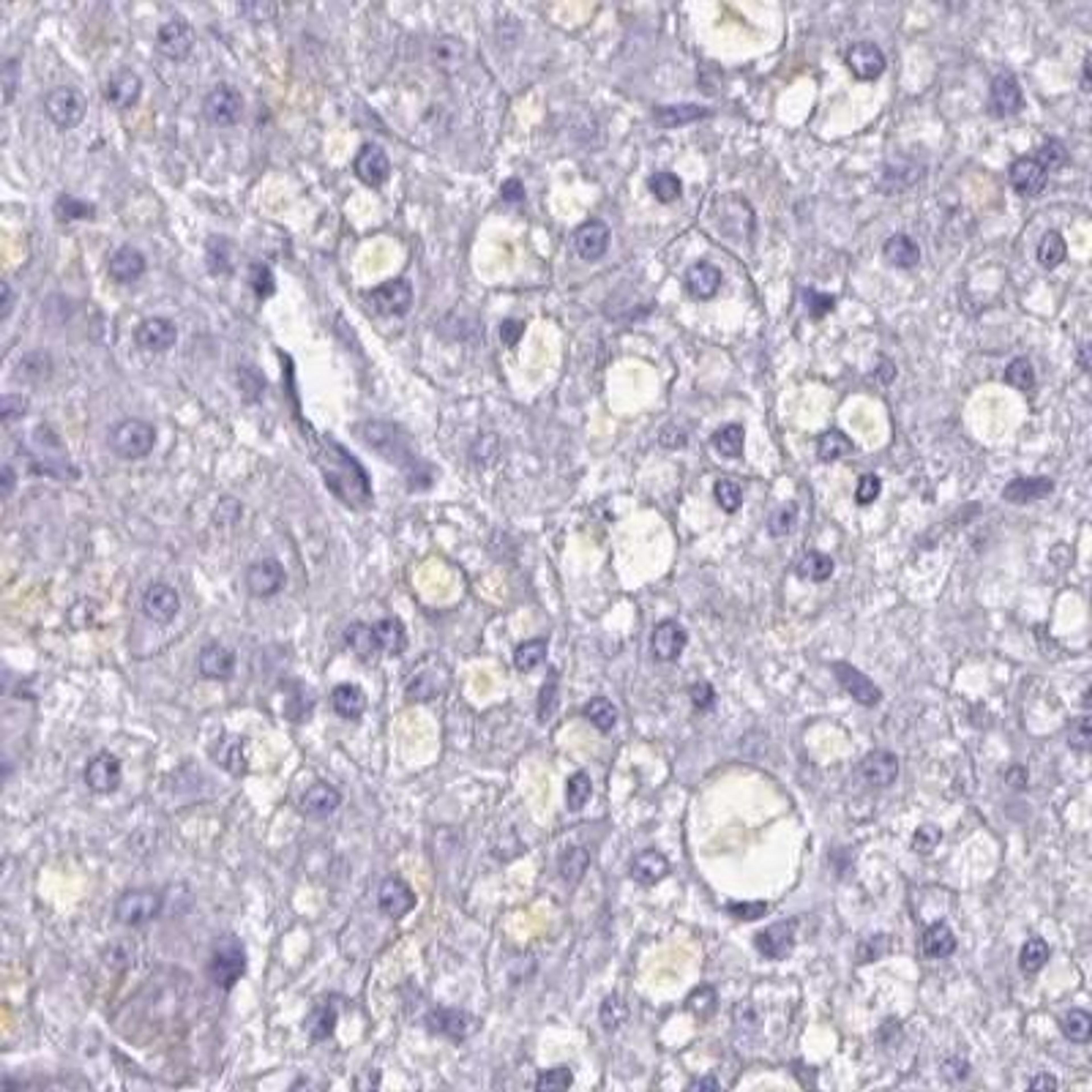 Immunohistochemistry: SATL1 Antibody [NBP2-32537] - liver cancer