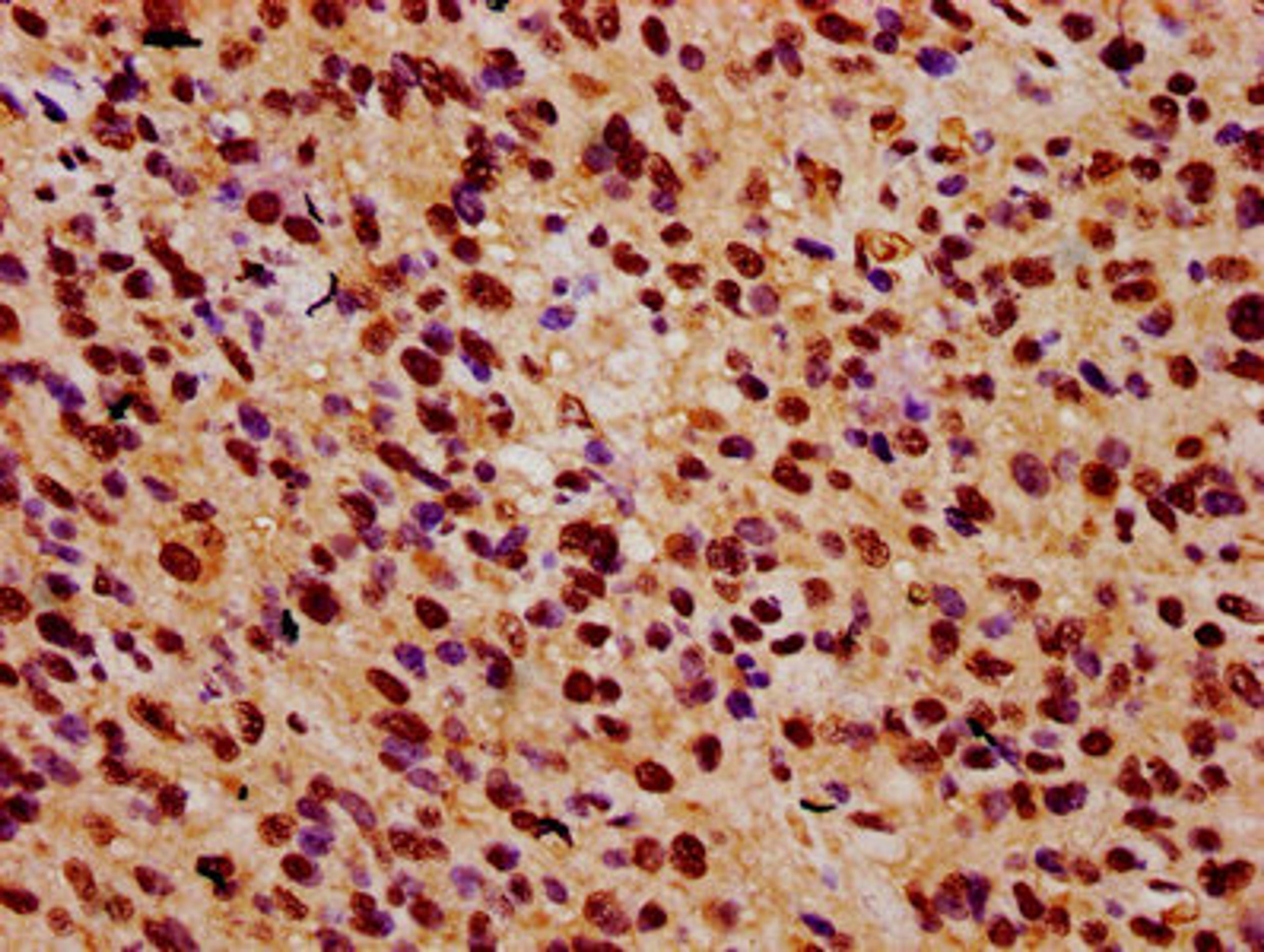 IHC image of CSB-PA026592LA01HU diluted at 1:500 and staining in paraffin-embedded human glioma performed on a Leica BondTM system. After dewaxing and hydration, antigen retrieval was mediated by high pressure in a citrate buffer (pH 6.0). Section was blocked with 10% normal goat serum 30min at RT. Then primary antibody (1% BSA) was incubated at 4&deg;C overnight. The primary is detected by a biotinylated secondary antibody and visualized using an HRP conjugated SP system.