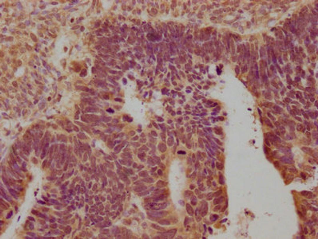 IHC image of CSB-PA016359OA01HU diluted at 1:100 and staining in paraffin-embedded human ovarian cancer performed on a Leica BondTM system. After dewaxing and hydration, antigen retrieval was mediated by high pressure in a citrate buffer (pH 6.0). Section was blocked with 10% normal goat serum 30min at RT. Then primary antibody (1% BSA) was incubated at 4°C overnight. The primary is detected by a biotinylated secondary antibody and visualized using an HRP conjugated SP system.