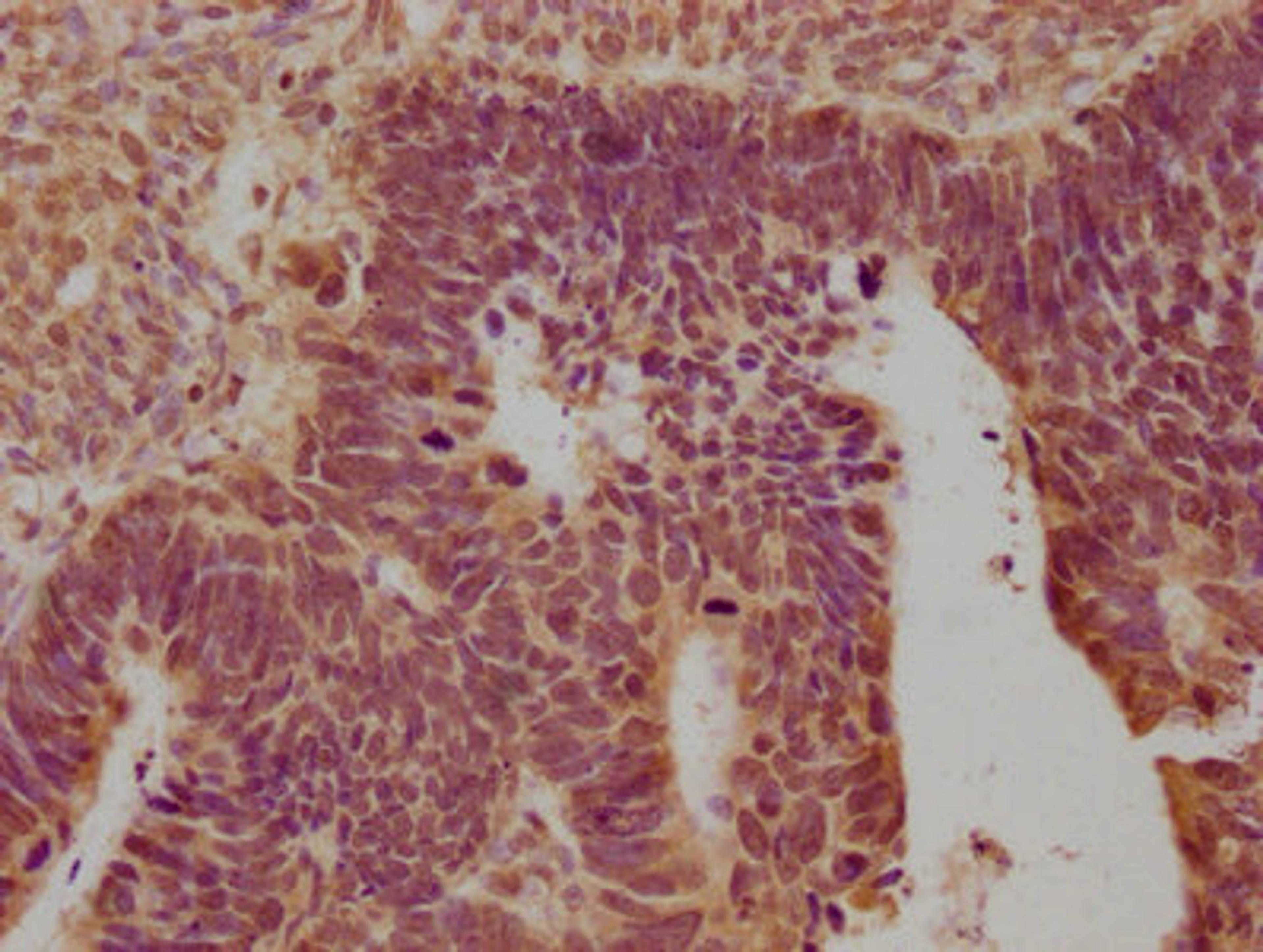 IHC image of CSB-PA016359OA01HU diluted at 1:100 and staining in paraffin-embedded human ovarian cancer performed on a Leica BondTM system. After dewaxing and hydration, antigen retrieval was mediated by high pressure in a citrate buffer (pH 6.0). Section was blocked with 10% normal goat serum 30min at RT. Then primary antibody (1% BSA) was incubated at 4°C overnight. The primary is detected by a biotinylated secondary antibody and visualized using an HRP conjugated SP system.