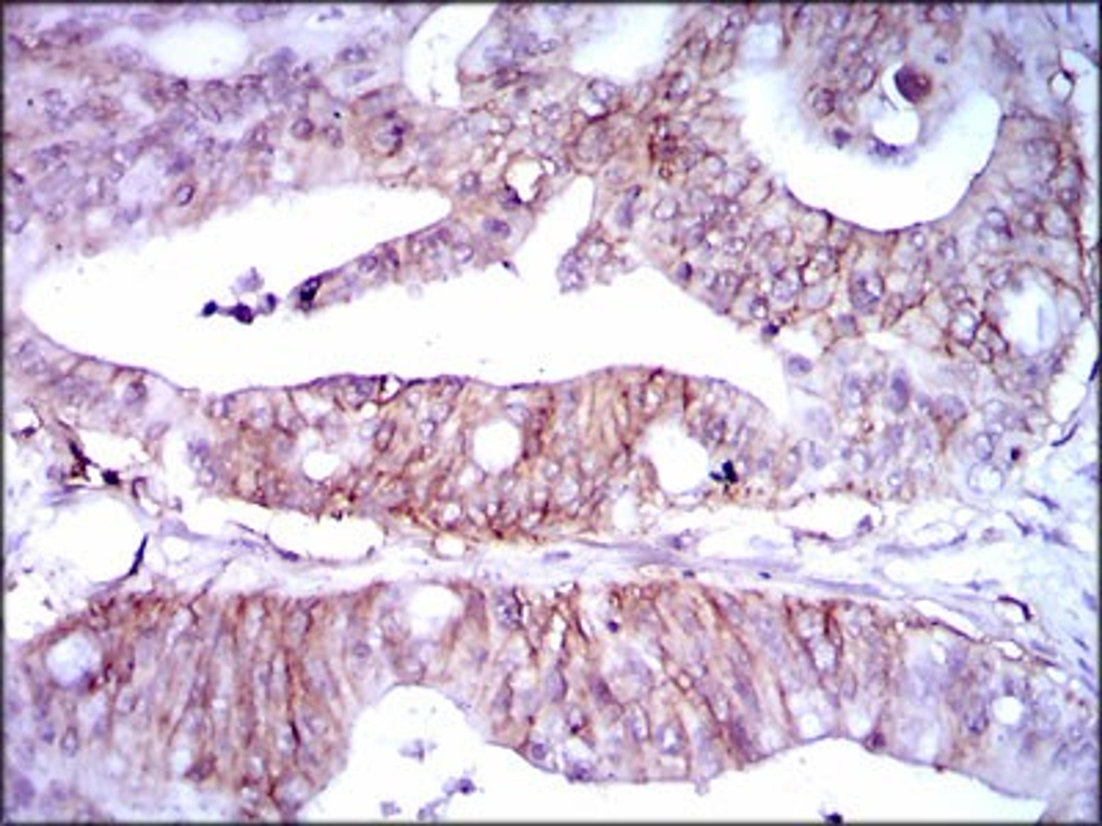 Immunohistochemistry: Lipoprotein a Antibody (4H1) [NBP2-37477] - Immunohistochemical analysis of paraffin-embedded rectum cancer tissues using LPA mouse mAb with DAB staining.