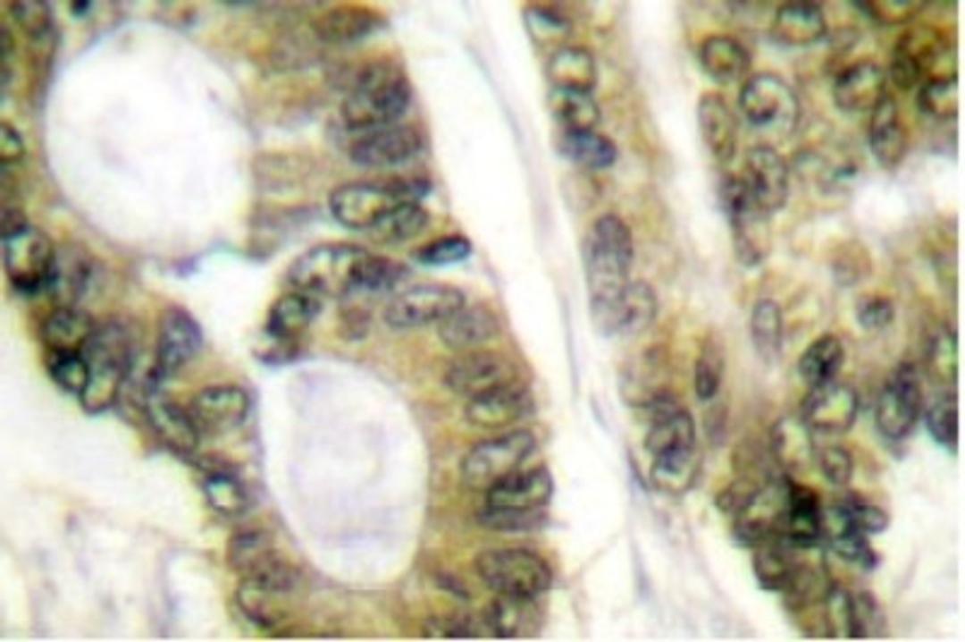 Immunohistochemistry-Paraffin: APC Antibody [NB100-91662] - Paraffin-embedded human colon carcinoma tissue.