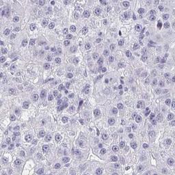 Immunohistochemistry: C20orf85 Antibody [NBP2-31709] - liver cancer