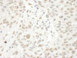 Immunohistochemistry: BRCAA1 Antibody [NBP1-26618] - FFPE section of human ovarian carcinoma.  Antibody used at a dilution of 1:250. Detection: DAB staining using Immunohistochemistry Accessory Kit.