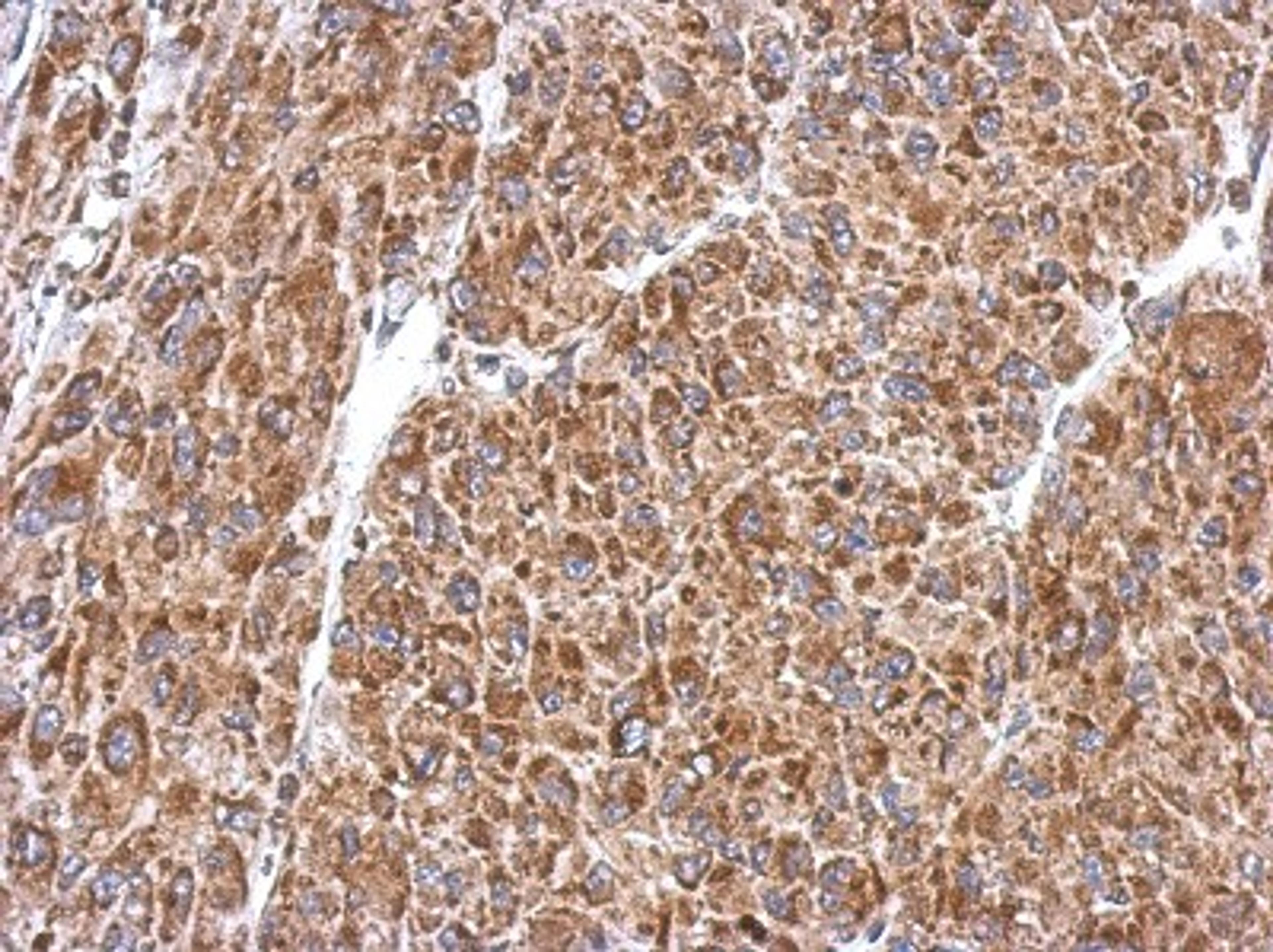 Immunohistochemistry-Paraffin: PIAS2 Antibody [NBP2-19819] - Immunohistochemical analysis of paraffin-embedded U87 xenograft, using antibody at 1:500 dilution.