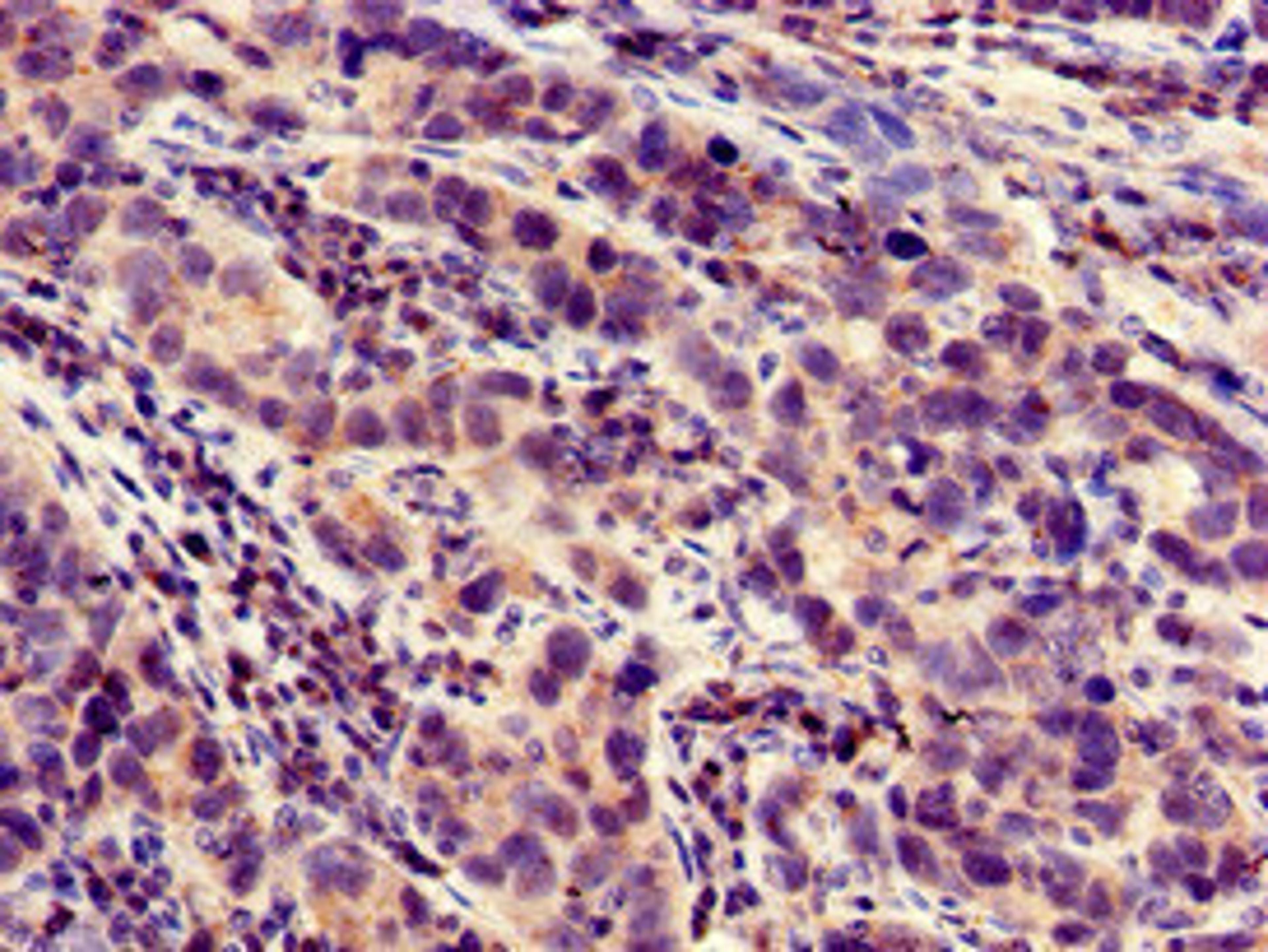 Immunohistochemistry of paraffin-embedded human pancreatic cancer using CSB-PA814211LA01HU at dilution of 1:100