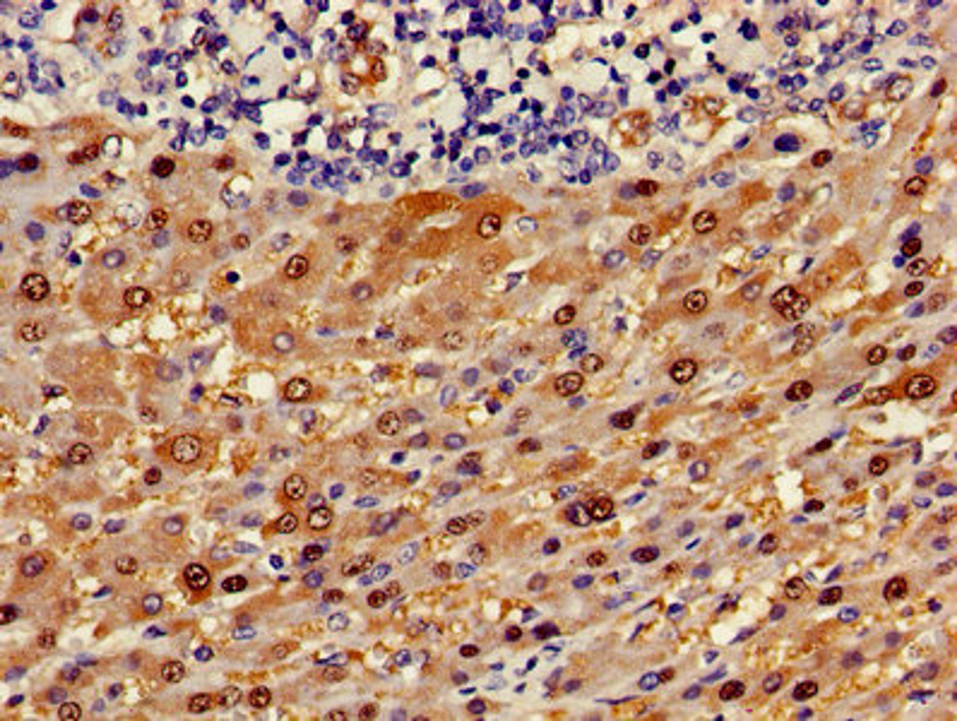 Immunohistochemistry of paraffin-embedded human liver cancer using CSB-PA002213LA01HU at dilution of 1:100